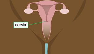 wow-l2-preventing-cervical-cancer-id10073-01.jpg